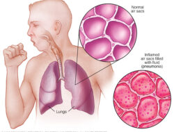 Pengertian Pneumonia