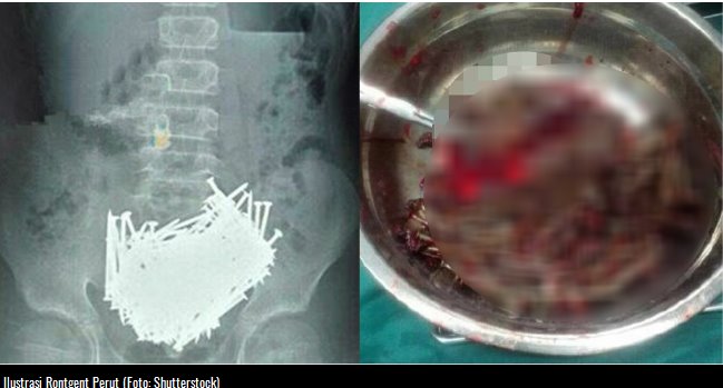 operasi paku dalam perut
