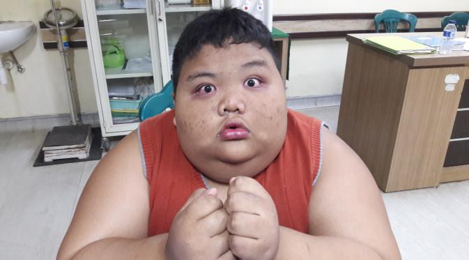 Rizki bocah obesitas